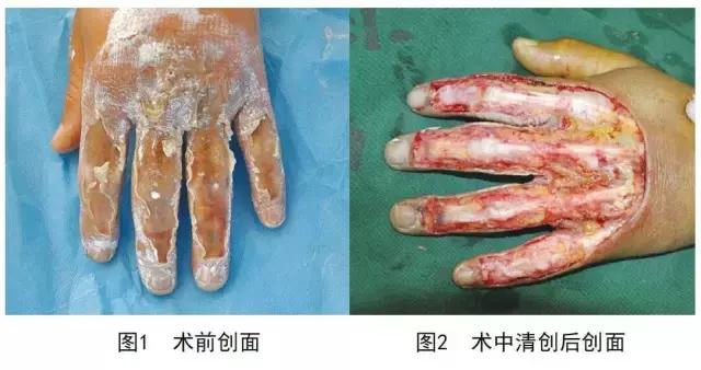 vsd负压引流加皮瓣移植,vsd植皮和皮瓣手术哪个损伤大