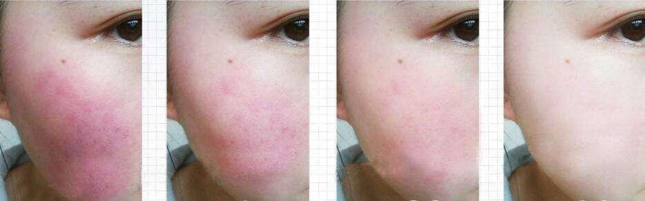 洋甘菊治红血丝吗,红血丝可以用洋甘菊吗