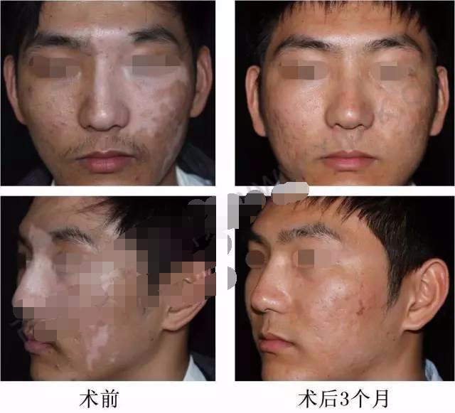 白癜风表皮移植能达到完全恢复吗,白癜风自体黑色素移植效果怎么样