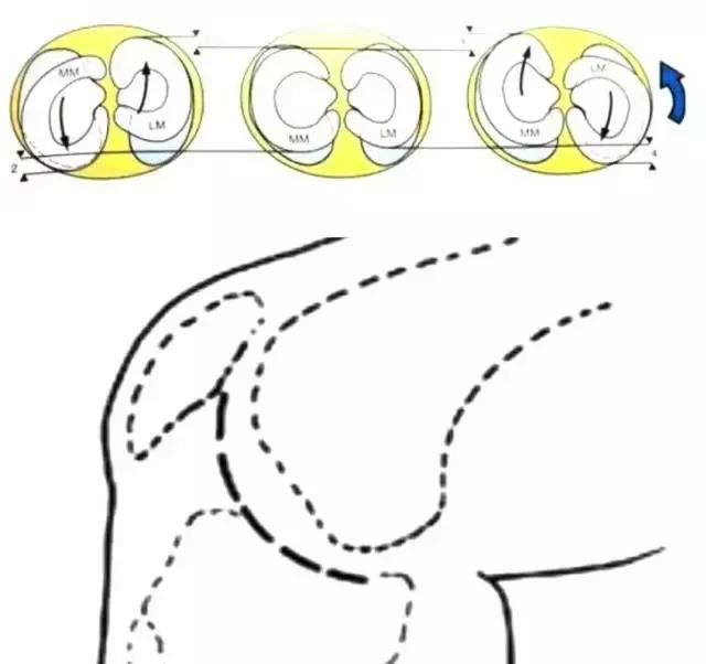 半月板左侧前角损伤最佳锻炼方法,膝关节半月板损伤2-3度怎样锻炼好