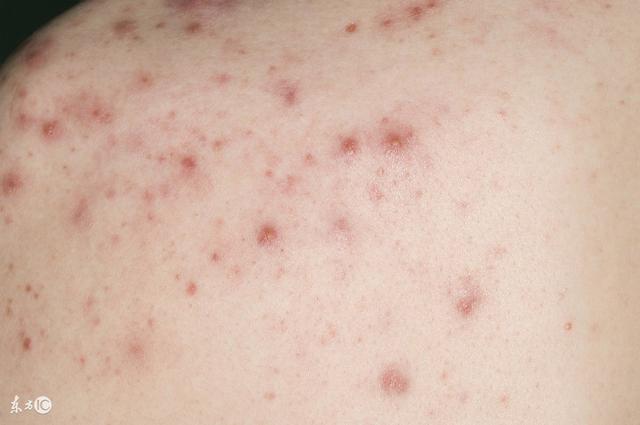 丘疹怎么护理才好得快,丘疹需要注意的饮食