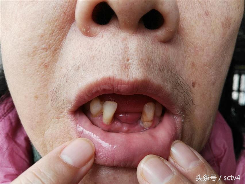 种植牙失败算医疗事故吗,种植牙医院医疗事故如何赔偿