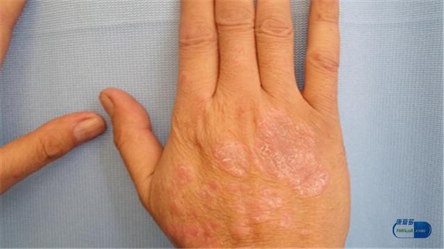 卡泊三醇治疗银屑病效果如何,卡泊三醇治银屑病的效果