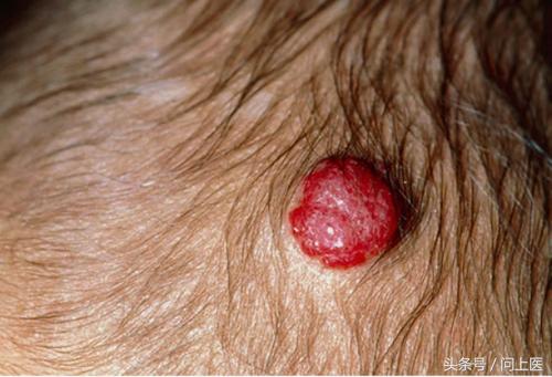 胎记原来是这样来的,你有胎记吗什么意思