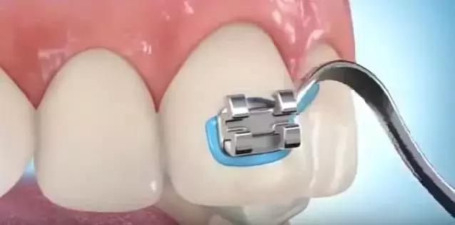 箍牙的牙套是怎么固定上去的,箍牙齿全过程图片
