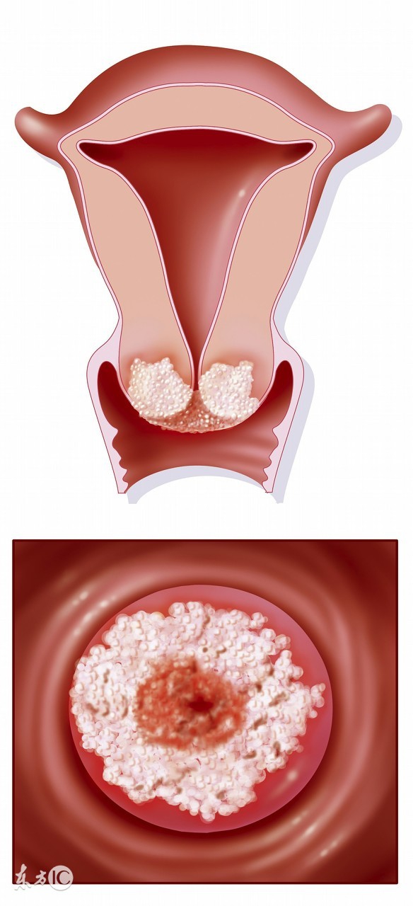 如何发现宫颈肥大，它的症状及病因又是什么
