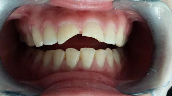 深圳麦芽口腔种牙靠谱吗,深圳麦芽口腔根管治疗多少钱