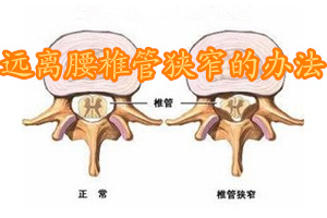 腰椎管狭窄吃什么中药见效快,腰椎管狭窄最佳锻炼方法视频