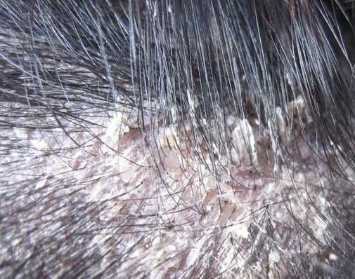 35岁美女大量掉发怎么办,22岁女掉发严重秃顶