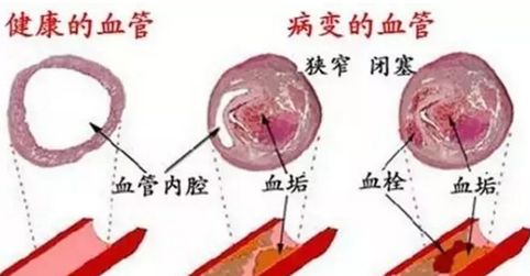 醋真有软化血管硬化的功效吗,长期喝酒预防血管硬化的保健品