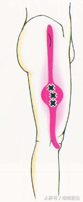 绝对干货膝盖损伤知识一网打尽,膝关节疼痛知识科普