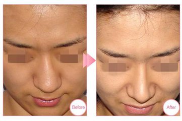 鼻中隔偏曲是什么玩意,鼻中隔偏曲有什么自愈方法吗