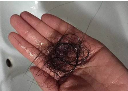 35岁美女大量掉发怎么办,22岁女掉发严重秃顶