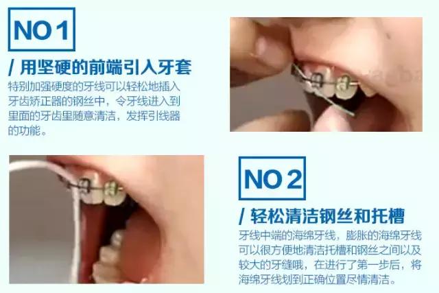 戴牙套如何清洁,牙套的清洁推荐