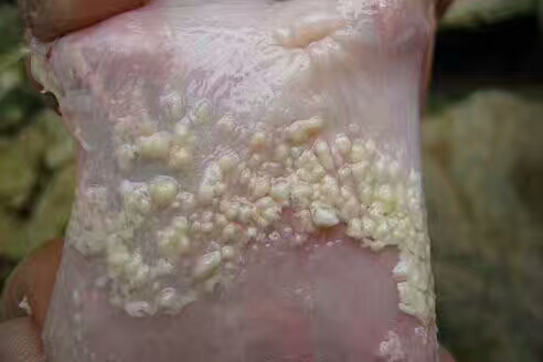 鸡念珠菌的症状及表现,白色念珠菌是什么原因形成的