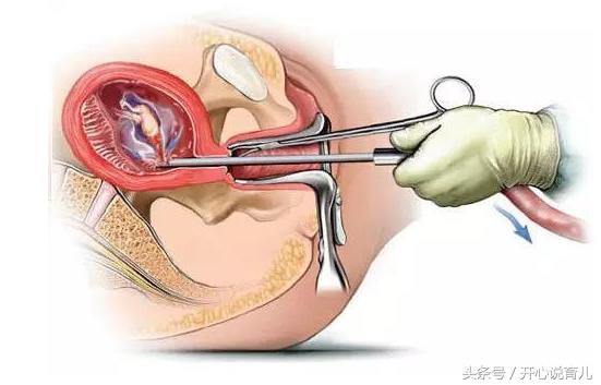 你以为上了环就能一劳永逸?更多的麻烦在等着你呢!