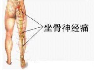 坐骨神经痛只需一招根除,腰间盘突出坐骨神经痛怎么治疗好