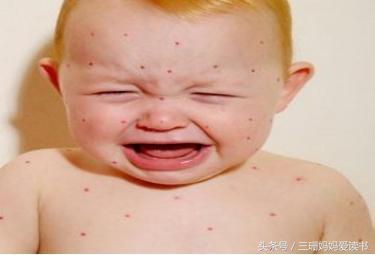 宝宝荨麻疹过敏反复起红疹怎么办,宝宝急性荨麻疹反反复复怎么办