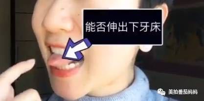 12岁孩子说话不清楚舌系带过短,2周岁8个月舌系带过短要不要剪