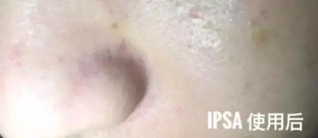 控油祛痘祛黑头粉刺闭口面膜推荐,哪种清洁面膜祛黑头粉刺有效果