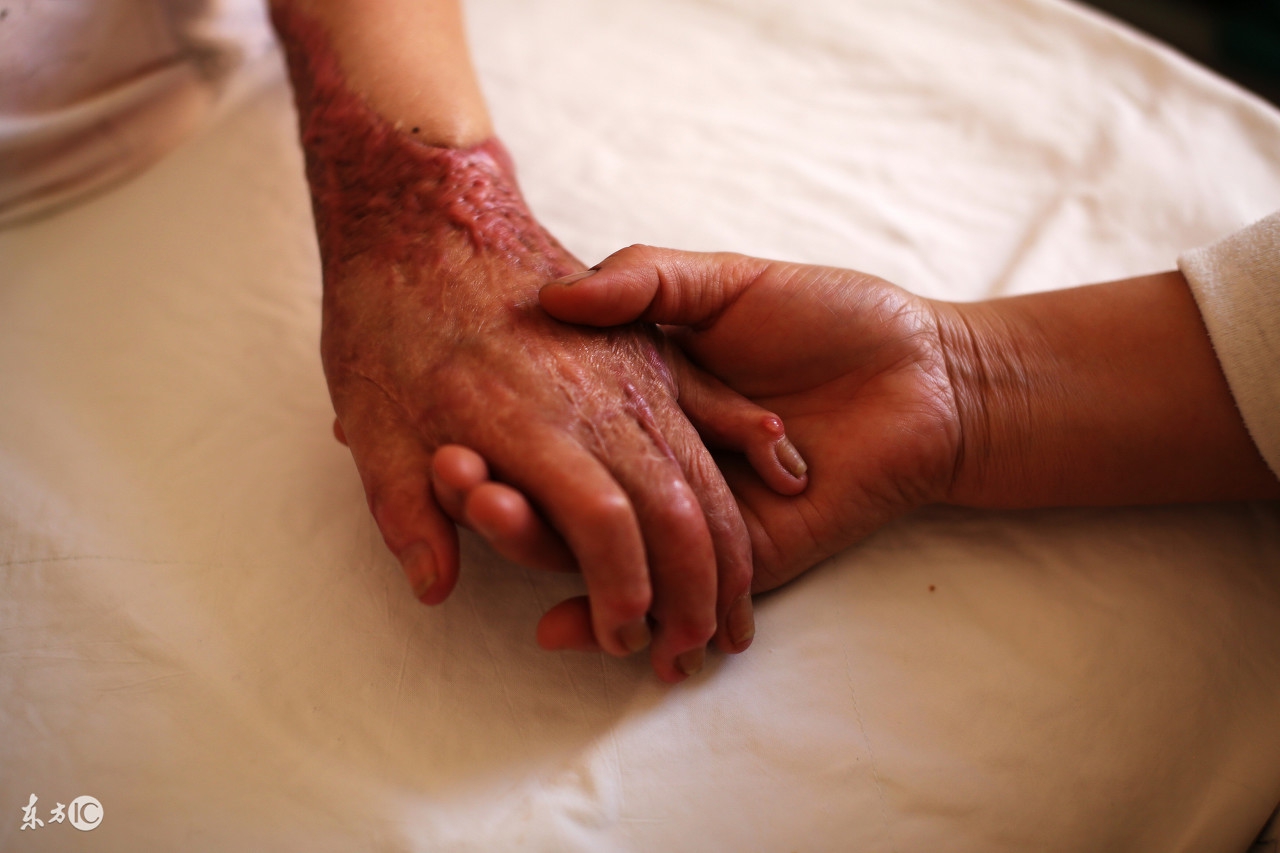 电烧伤创面应怎样处理,外伤创面处理原则