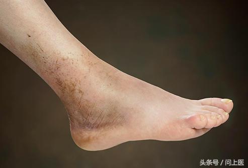 脚部麻木是怎么一回事,脚部肿胀走路就疼是啥原因