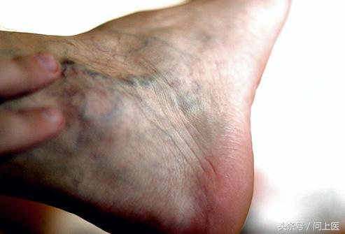 脚部麻木是怎么一回事,脚部肿胀走路就疼是啥原因
