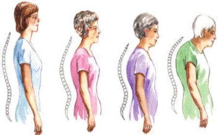 骨质疏松压缩性骨折治疗指南2022,骨质疏松脊柱骨折诊疗指南