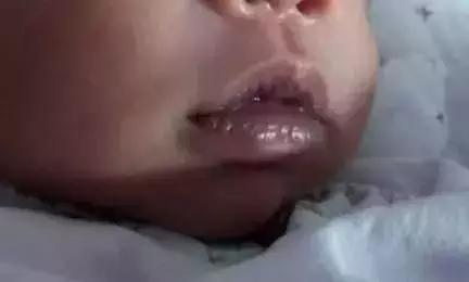 嘴唇变紫是心脏病吗,嘴唇变色是什么原因引起的