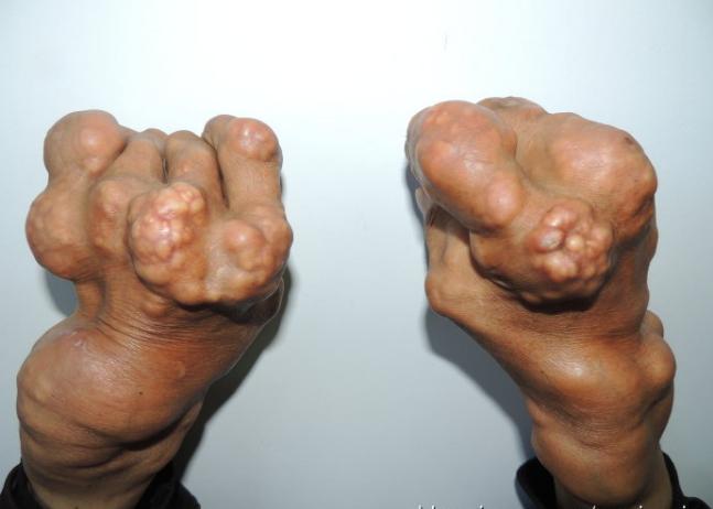 痛风患者六不宜痛风病友要牢记,医生说痛风最好忌口