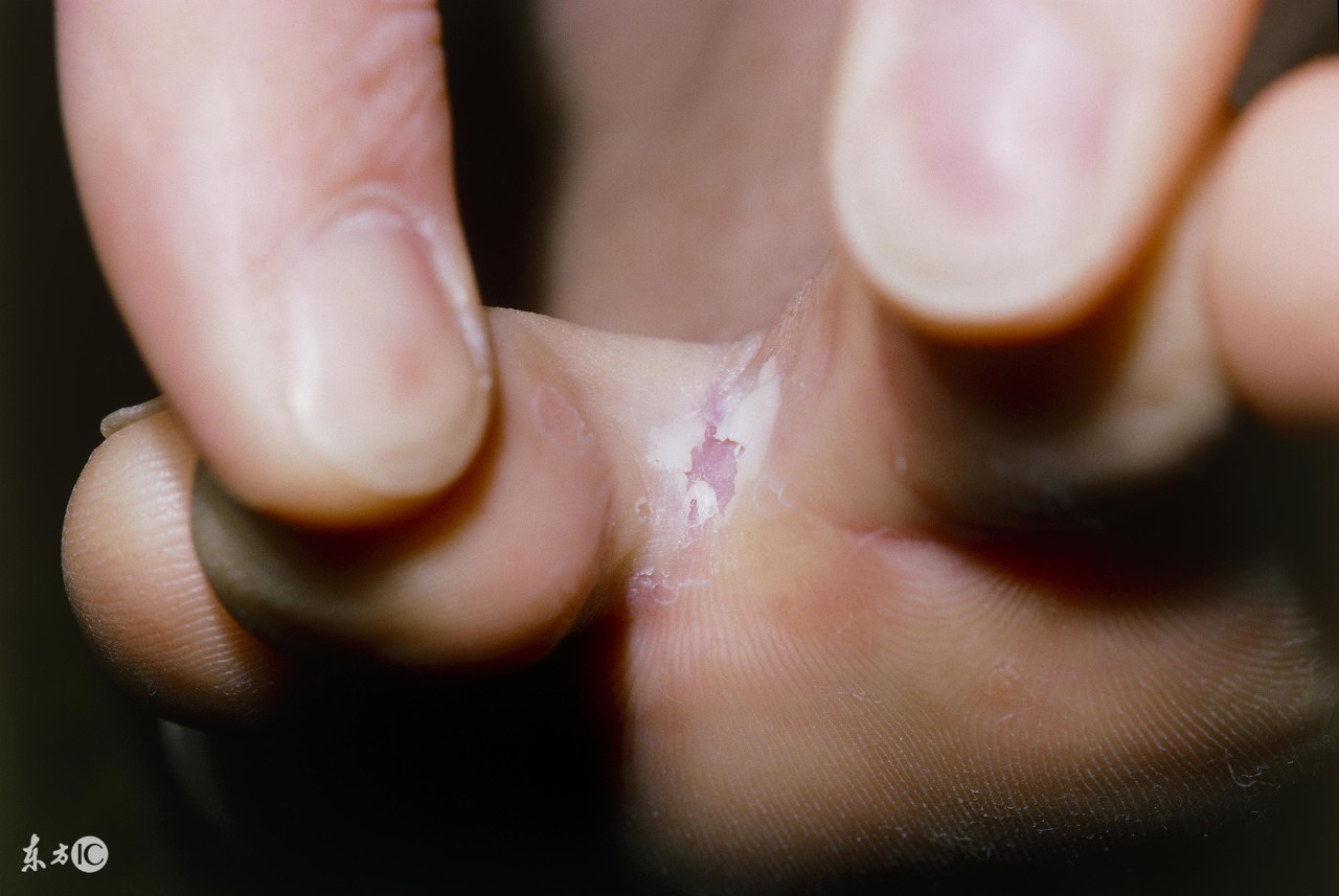 脚气脚臭脚汗用什么药最管用,有脚气灰指甲脱皮脚臭怎么根治