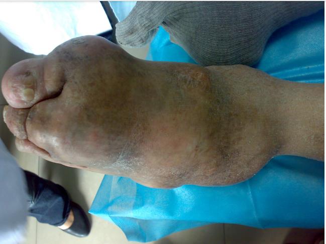 痛风患者六不宜痛风病友要牢记,医生说痛风最好忌口