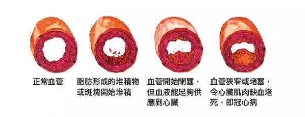 清除血管壁脂类吃什么,血管油脂堵塞怎么快速清理