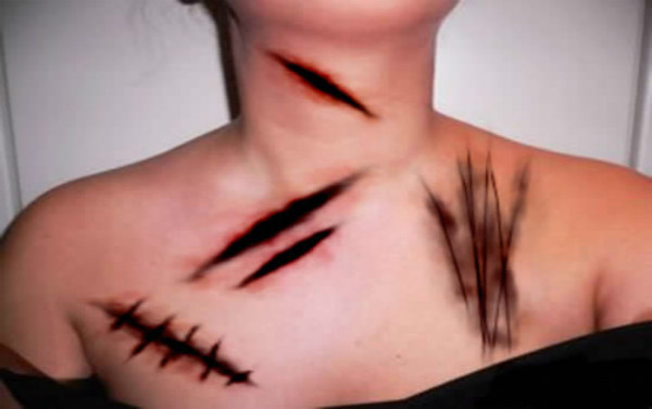 疤痕不算什么病痛才可怕,疤痕真的是不可逆的吗