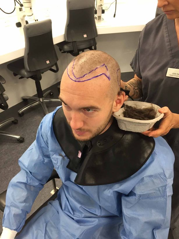 英国球星鲁尼植发,鲁尼植发真实视频