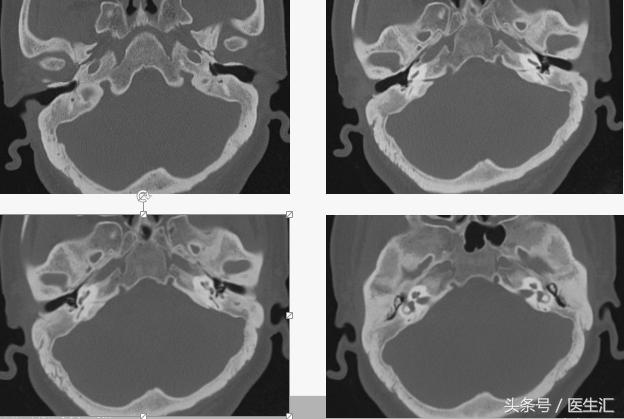 听力低频下降怎么恢复,低频听力下降耳鸣怎么治疗