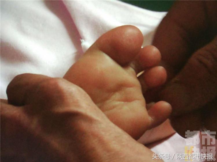 8岁女童急性脊髓炎四肢瘫痪,三岁小孩得急性脊髓炎能治好吗