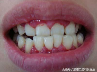 泉州人要警惕，有一种口腔疾病正在侵蚀青少年的牙！