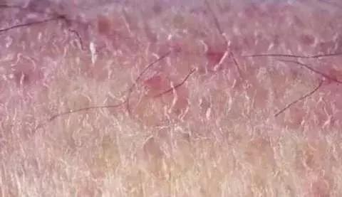 干皮缺水出油长痘用什么护肤,皮肤干燥缺水会长痘吗