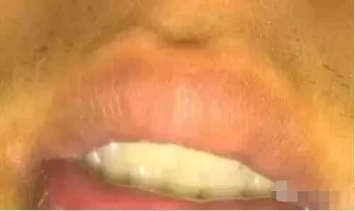 嘴唇变紫是心脏病吗,嘴唇变色是什么原因引起的