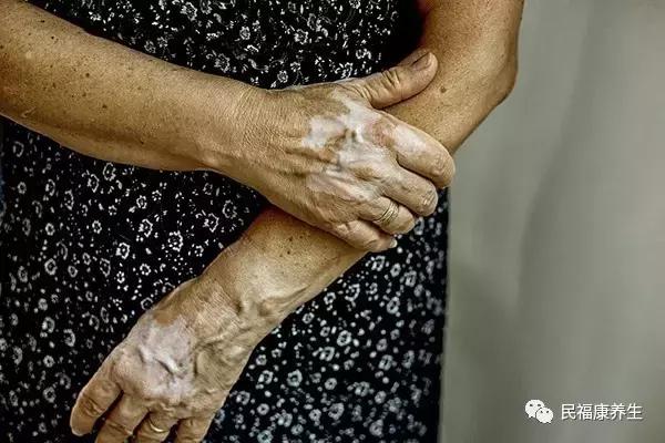 白癜风初期症状怎么辨别,白癜风早期自己怎样判断