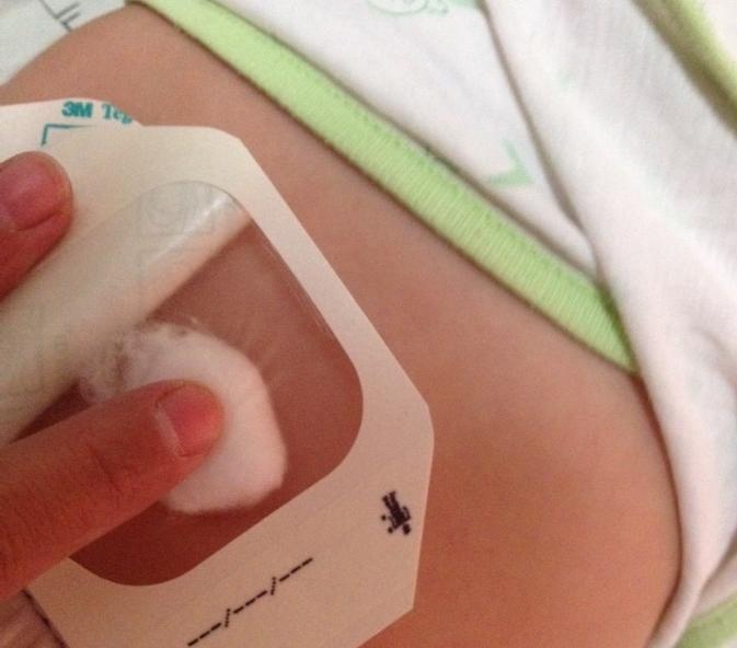 宝宝肚脐胀气肚脐突出来怎么回事,50多天的婴儿肚脐突出是怎么回事