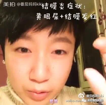 宝宝眼睛都是眼屎粘住了,宝宝眼睛被黄色眼屎糊住