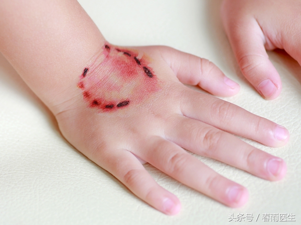 被人咬了，除了让TA赔钱，你还必须这么做！