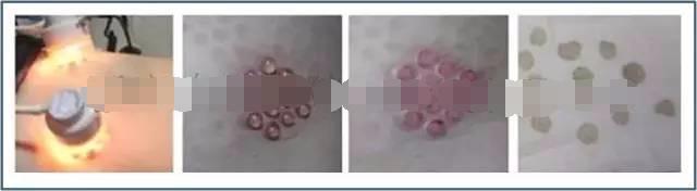 白癜风表皮移植能达到完全恢复吗,白癜风自体黑色素移植效果怎么样