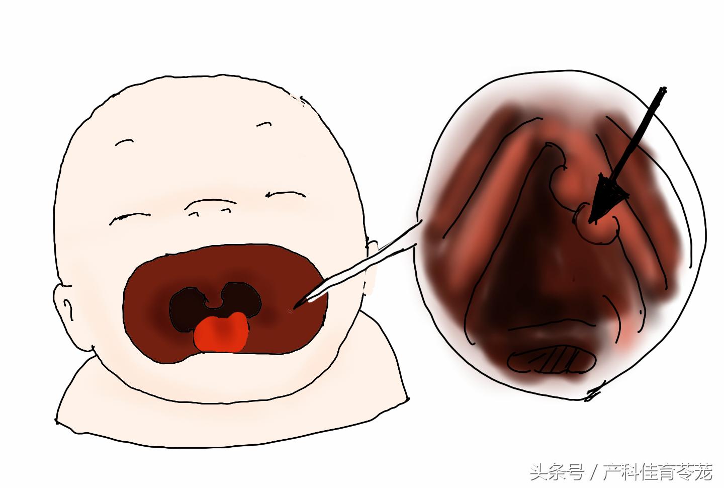 妊娠期感染hpv严重吗,妊娠期hpv