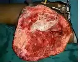 创面伤口感染如何处理,如何预防创面感染