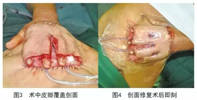 vsd负压引流加皮瓣移植,vsd植皮和皮瓣手术哪个损伤大