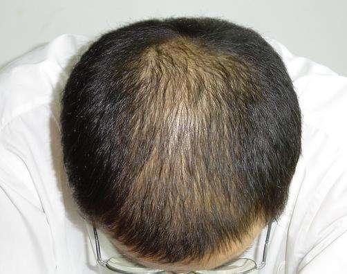 脱发食疗与用药怎样防止脱发,脱发吃什么食物才能治疗