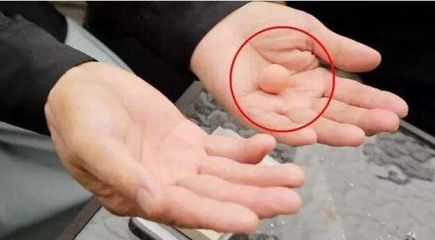 女子腹部有小包块，2次手术切除还是复发，专家揭示其中原因